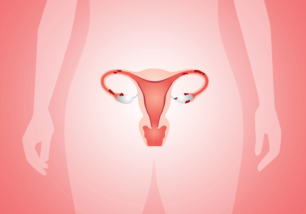 Quais são os sintomas da endometriose? 1 sintomas da endometriose